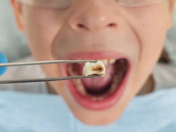 Best Dental Abscess Treatment in Lewisburg, PA