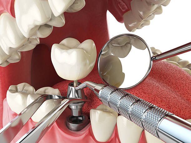 Best Knocked-Out Tooth (Avulsed Tooth) Treatment in Lewisburg, PA